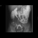 Crohn's disease of ileum: RF - Fluoroscopy